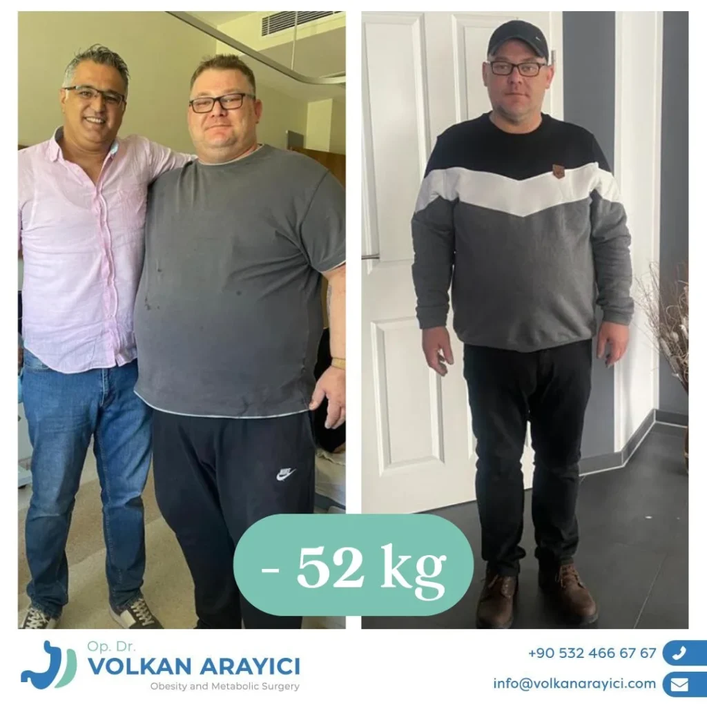 alkoholkonsum nach einer Schlauchmagen op