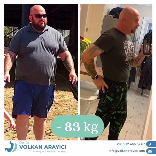 Magenbypass vorher nachher: Patient 83 Kilo leichter