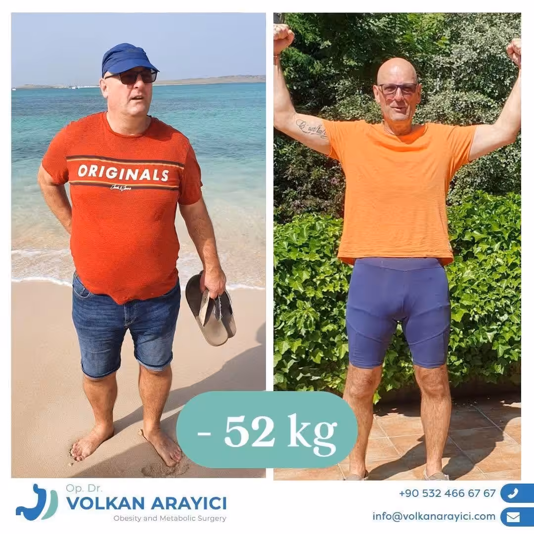 Re-Sleeve vorher nachher: Patient 52 Kilo leichter