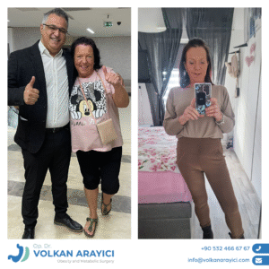 Schlauchmagen Turkei Vorher Nachher