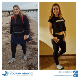 Schlauchmagen Turkei Vorher Nachher