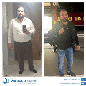 Schlauchmagen Turkei Vorher Nachher