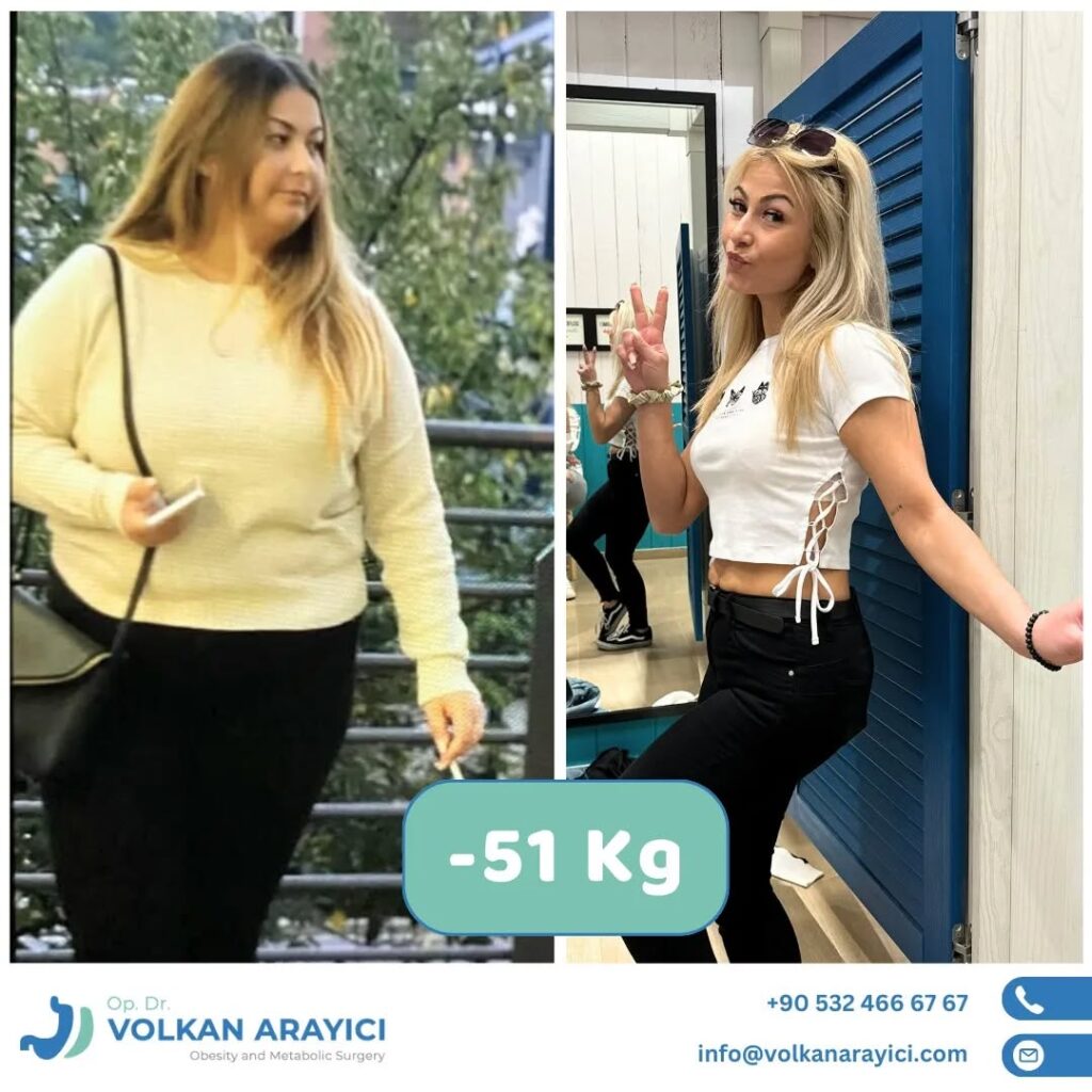 schlauchmagen Op Türkei vorher nachher